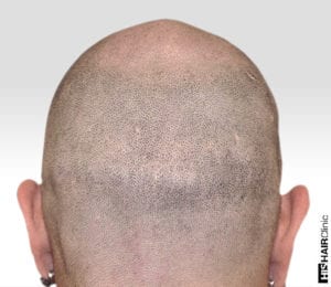 Can You Hide A Hair Transplant Scar Using SMP® 1