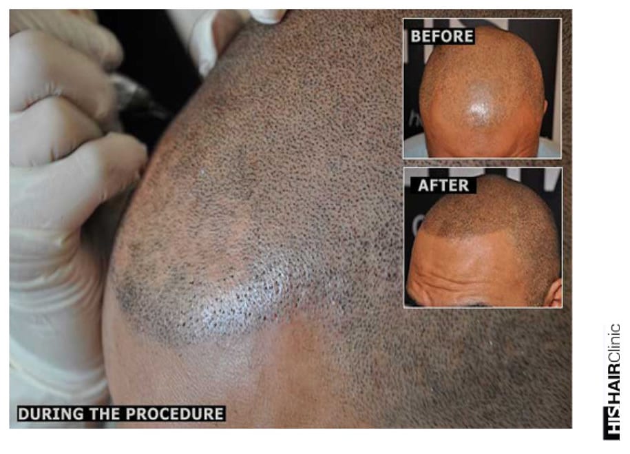 WHAT IS SMP® SCALP MICROPIGMENTATION